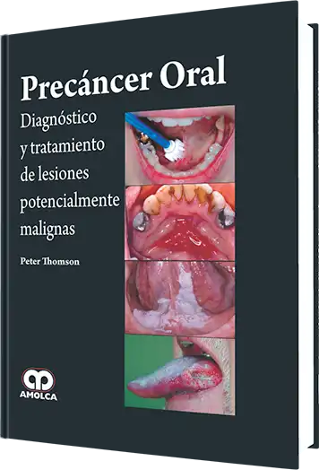 Precáncer Oral.  Diagnóstico y Tratamiento de Lesiones Potencialmente Malignas