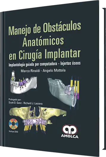 Manejo de Obstáculos Anatómicos en Cirugía Implantar